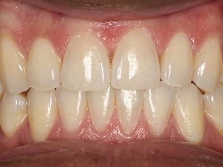 Straight teeth after treatment