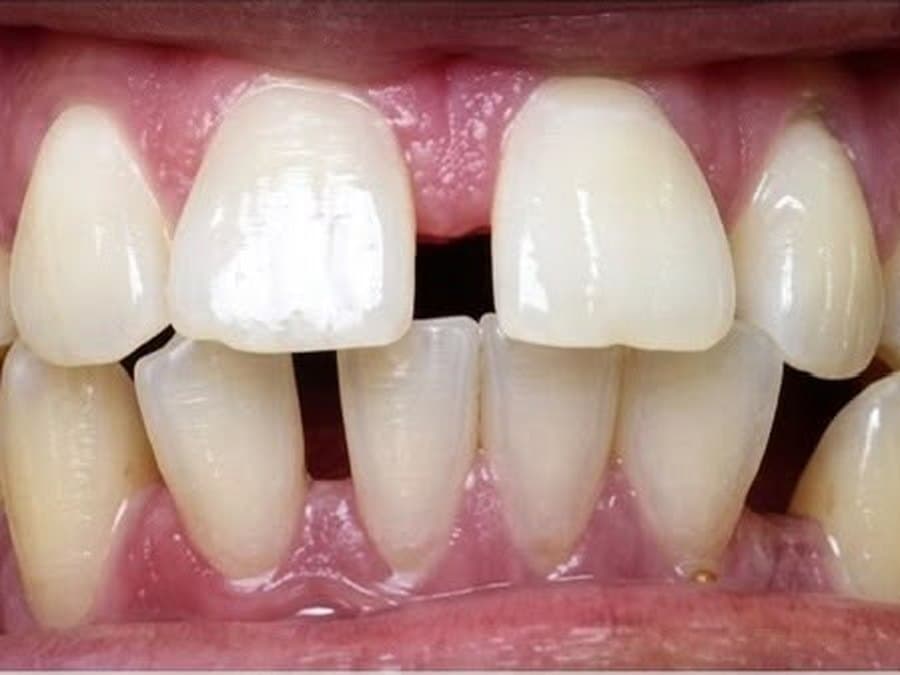 Crowded teeth before treatment