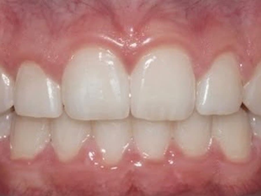 Gap closed after treatment