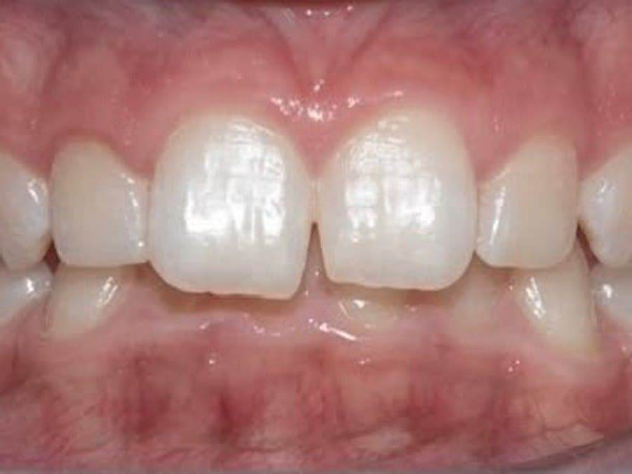 Gap between front teeth before treatment