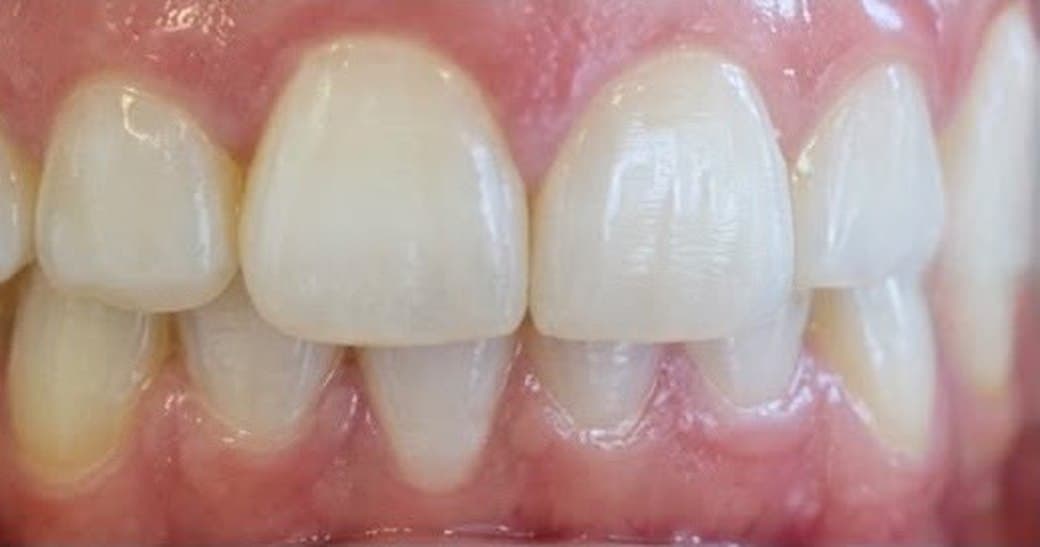 Corrected bite after treatment