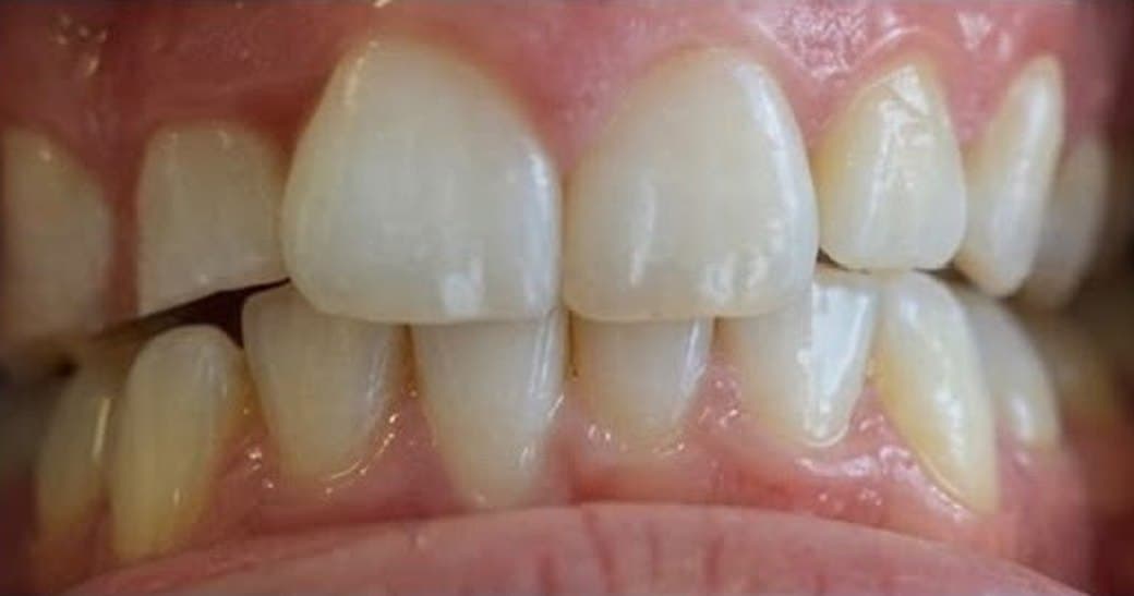 Overbite before treatment