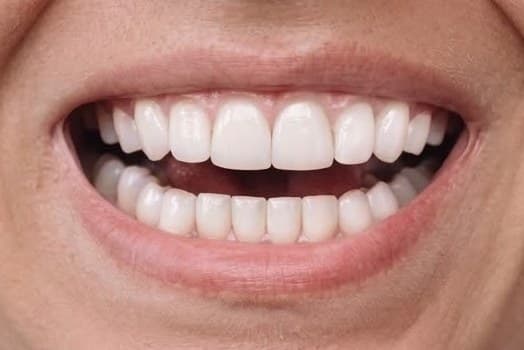 The straightened smile after treatment